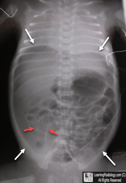 Pneumoperitoneum